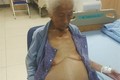 Phẫu thuật thành công lấy khối u khổng lồ trong ổ bụng cụ bà 100 tuổi