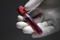Dụng cụ phát hiện nhanh ung thư bằng mẫu máu