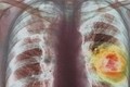 Phát hiện hormone giúp hóa trị điều trị ung thư phổi đạt hiệu quả cao hơn