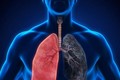 Sử dụng kim loại nặng gallium trong điều trị nhiễm trùng phổi