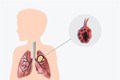 Phương pháp tầm soát ung thư phổi chỉ cần xét nghiệm máu đơn giản