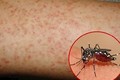 Kon Tum: Một trường hợp tử vong do Sốt xuất huyết Dengue
