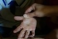 Lấy mẫu phân tích, xác định bệnh lý để sớm có phương án điều trị bệnh ngứa chân tay cho học sinh ở huyện Tủa Chùa 
