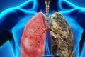  Hệ thống AI giúp phát hiện sớm ung thư phổi