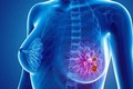 Loại thuốc mới giúp tăng cơ hội sống cho bệnh nhân ung thư vú