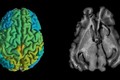 Kỹ thuật MRI mới giúp sớm phát hiện các căn bệnh thoái hóa thần kinh