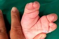 Sửa dị tật bàn tay, bàn chân như hình càng cua cho bệnh nhi 2 tuổi