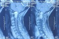 Phẫu thuật thành công ca bệnh khó “U rễ thần kinh vùng chẩm cổ”