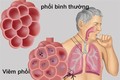 Bộ Y tế khuyến cáo về phòng chống viêm phổi cấp do chủng vi rút mới tại Trung Quốc