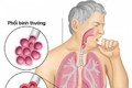 Việt Nam có số bệnh nhân mắc nấm phổi xâm lấn cao nhất thế giới
