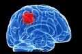 Cảnh báo u não dễ nhầm với các bệnh khác