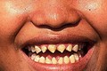Cưa răng là nghi lễ đánh dấu sự trưởng thành của trai, gái Cơ Tu