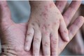 越南需准备好应对猴痘疫情的方案