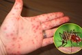  Lâm Đồng: Chủ động phòng, chống bệnh sốt xuất huyết, tay chân miệng