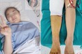 越南成功对年龄最小的患者进行股骨头的置换手术