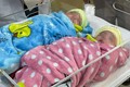 越南中央妇产医院首次成功保育胎龄25周出生体重仅500克的双胞胎