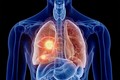 Hoạt động thể chất giúp ích cho những bệnh nhân ung thư phổi giai đoạn cuối