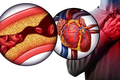 Nguy cơ mắc bệnh tim liên quan hạt vi nhựa bám trong động mạch