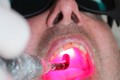 Liệu pháp laser mức độ thấp điều trị hội chứng bỏng rát miệng