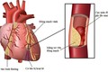 Báo động tình trạng thừa cholesterol gây các bệnh lý về tim mạch