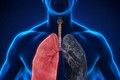 Giới chuyên gia Mỹ: Cần thêm thử nghiệm đối với thuốc điều trị ung thư phổi của Innovent và Eli Lilly