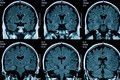 Dấu hiệu lão hóa sớm ở não bộ thanh thiếu niên sau đại dịch COVID-19