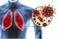 Phát hiện nguyên nhân gây tổn thương phổi ở người mắc COVID-19
