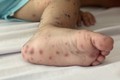 Nốt hồng ban ở chân của một trẻ mắc bệnh tay chân miệng. Ảnh: Đinh Hằng -TTXVN
