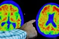 Hình ảnh não của bệnh nhân Alzheimer khi chụp PET. Ảnh: Reuters