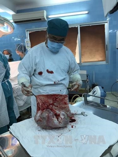 Thành phố Hồ Chí Minh: Phẫu thuật khối u buồng trứng nặng 35 kg