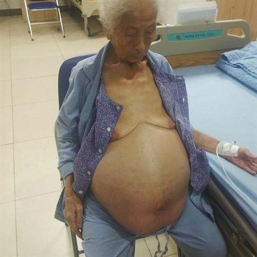 Phẫu thuật thành công lấy khối u khổng lồ trong ổ bụng cụ bà 100 tuổi