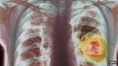Phát hiện hormone giúp hóa trị điều trị ung thư phổi đạt hiệu quả cao hơn