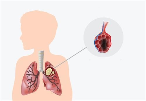 Phương pháp tầm soát ung thư phổi chỉ cần xét nghiệm máu đơn giản