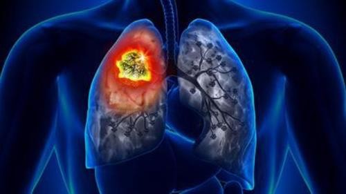 Xác định loại gen mở ra hy vọng cho bệnh nhân ung thư phổi