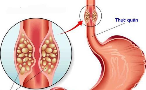 Trung Quốc phát triển mô hình chẩn đoán ung thư thực quản có độ chính xác cao