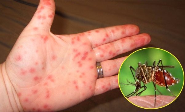  Lâm Đồng: Chủ động phòng, chống bệnh sốt xuất huyết, tay chân miệng