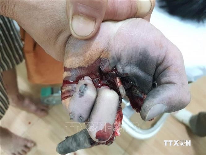 Vừa sạc điện thoại vừa chơi game, một thiếu niên bị nổ nát bàn tay ở Bình Phước