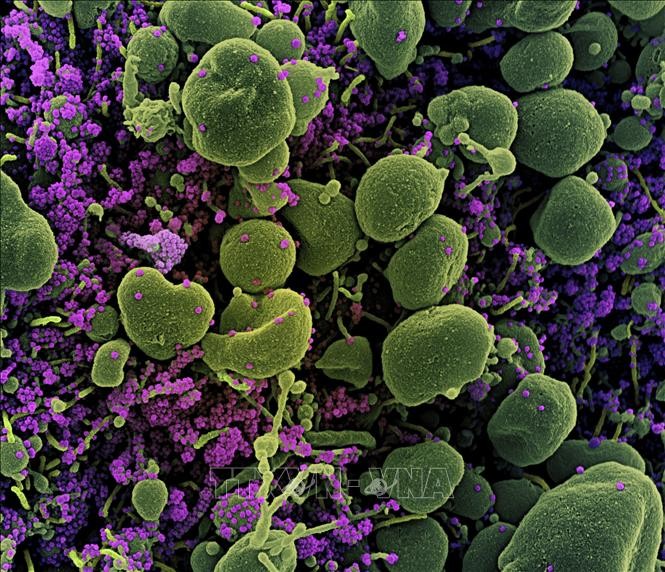 Hình ảnh quét qua kính hiển vi điện tử cho thấy tế bào (màu xanh) bị virus SARS-COV-2 (màu tím) xâm nhập trên mẫu bệnh phẩm của bệnh nhân COVID-19 tại Viện Nghiên cứu Dị ứng và Bệnh Truyền nhiễm Quốc gia ở Fort Detrick, Maryland, Mỹ ngày 15/7/2020. Ảnh: A
