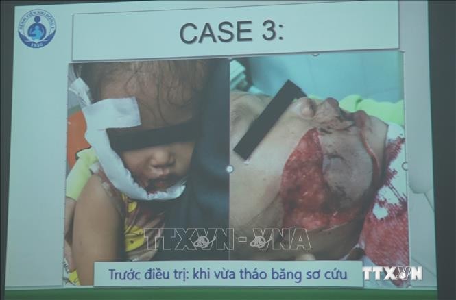 Thành phố Hồ Chí Minh: Cảnh báo tai nạn thương tích trẻ em do chó cắn
