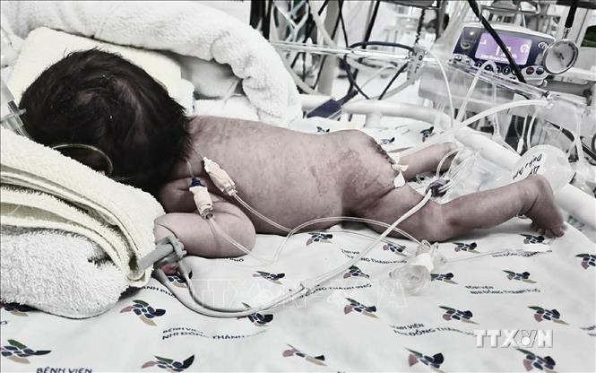 Thành phố Hồ Chí Minh: Phối hợp sản - nhi phẫu thuật thành công bướu quái khổng lồ ở trẻ sơ sinh