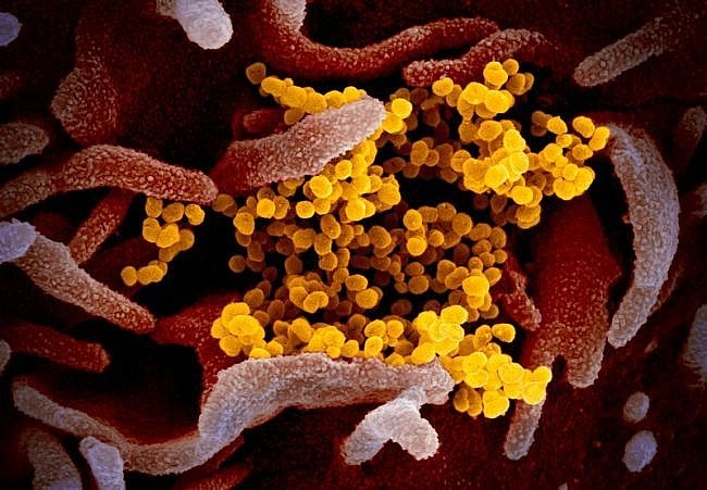 Virus corona chủng mới sinh sôi bám trên tế bào cơ thể người bị nhiễm - Ảnh: NIAID-RML