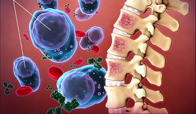 Phương thức điều trị bệnh đa u tủy xương mới dựa trên công nghệ RNA