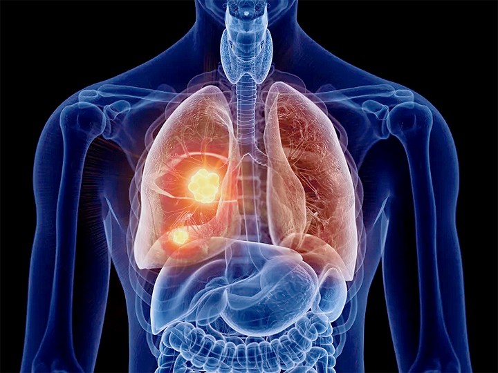 Hoạt động thể chất giúp ích cho những bệnh nhân ung thư phổi giai đoạn cuối