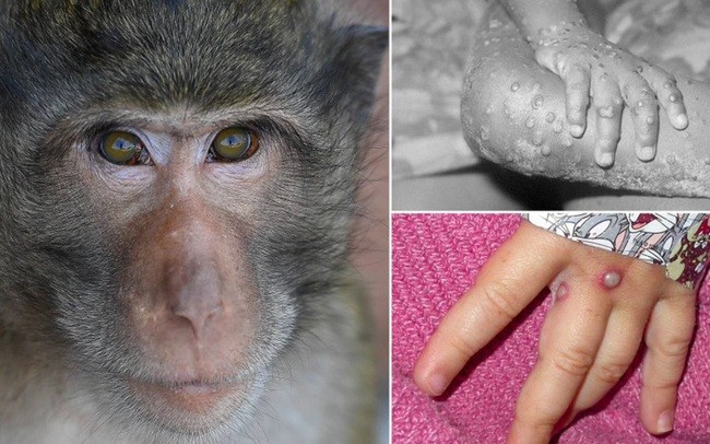 Bộ Y tế khuyến cáo 6 biện pháp phòng bệnh Đậu mùa khỉ