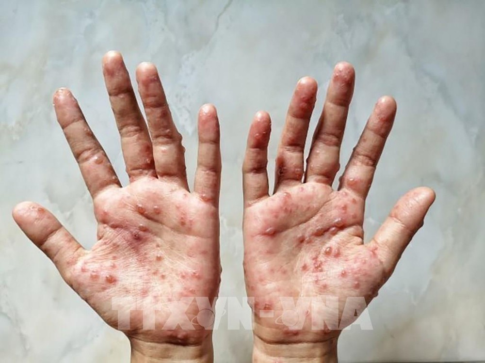 Các ban đỏ nổi trên tay một bệnh nhân mắc bệnh đậu mùa khỉ. Ảnh: Shutterstock/TTXVN