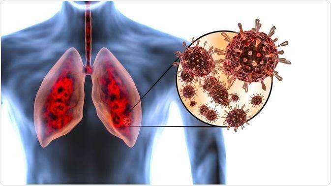 Phát hiện nguyên nhân gây tổn thương phổi ở người mắc COVID-19