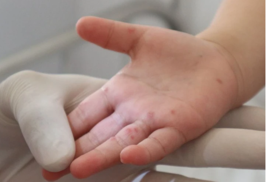 Đắk Lắk ghi nhận bệnh nhi 2 tuổi tử vong vì tay chân miệng