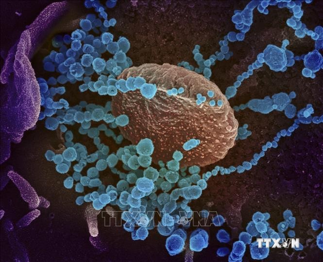 Virus SARS-CoV-2 (màu xanh) trên bề mặt các tế bào lấy từ mẫu bệnh phẩm của một bệnh nhân nhiễm COVID-2 tại Mỹ. Ảnh: AFP/TTXVN