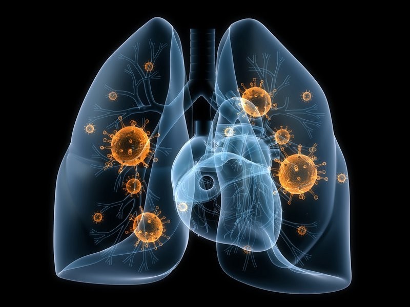 Các bệnh về phổi là một trong những bệnh lý phổ biến nhất trên thế giới. Ảnh : vinmec.com